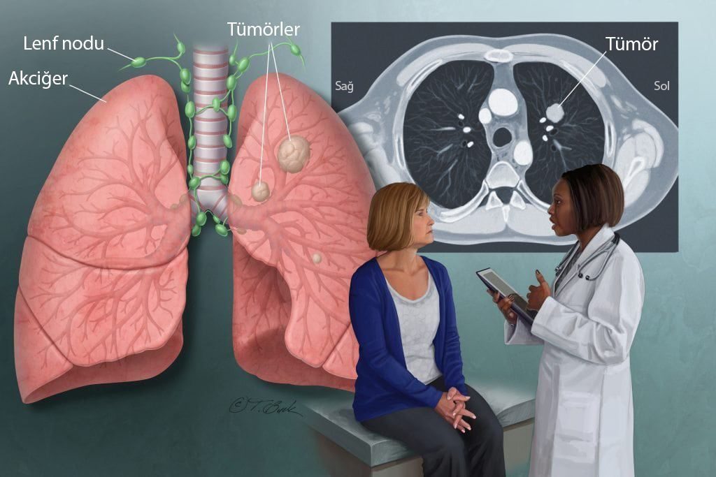 AKGÜN’den Akciğer Kanserine Erken Teşhis Sistemi (Mayıs 2019, Habercuk)